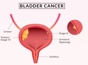 bladder cancer