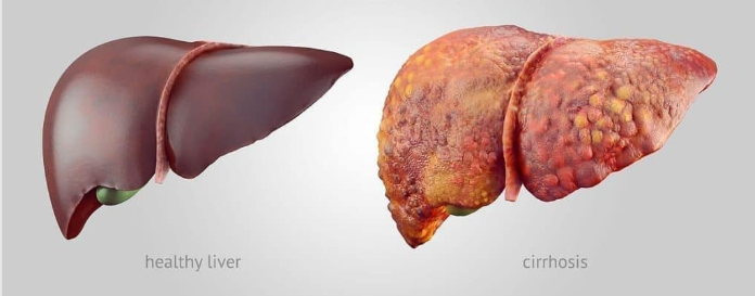 Understanding Liver Cancer