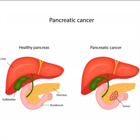 Understanding Pancreatic Cancer